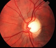 Fondo oculare di glaucomatoso (la zona biancastra &egrave; il nervo ottico danneggiato)