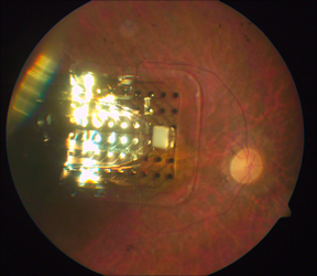 Sensori della retina artificiale visibili sul fondo oculare (Foto: artificialretina.energy.gov)