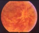 Occlusione venosa retinica