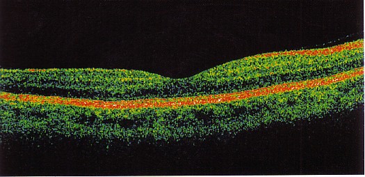 Tomogramma (OCT) di una retina sana