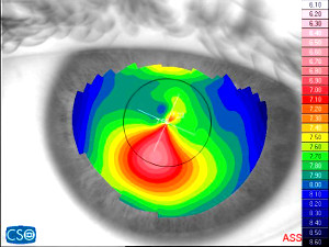 Topografia corneale (malato di cheratocono: la superficie dell'occhio appare deformata nella zona rossa)