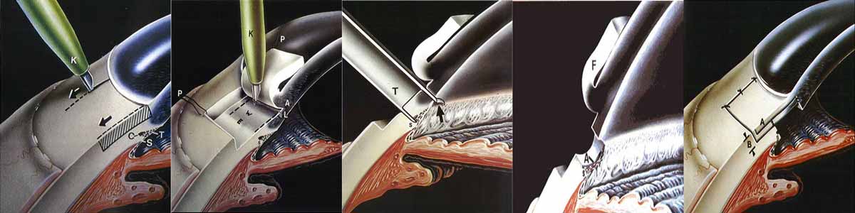 L'intervento di trabeculectomia consiste nell'incisione del limbus corneo-sclerale contenente il trabecolato e il canale di Schlemm per creare uno 